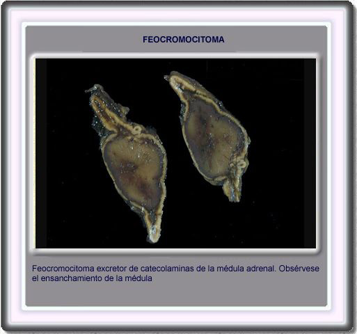 feocromocitoma1.jpg