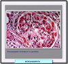 Microangiopatas glomerulares