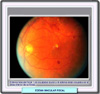 Fotografa de un fondo de ojo con  edema macular focal