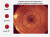 Clasificacin del edema macular
