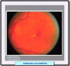 Edema macular. Fondo de ojo antes de un tratamiento