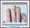 Atrofia de los dedos en la acrodermatitis continua