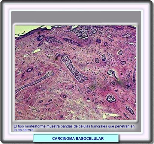 Histologa del carcinoma basocelular morfeamrfico