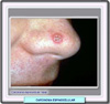 Carcinoma espinocelular en la nariz