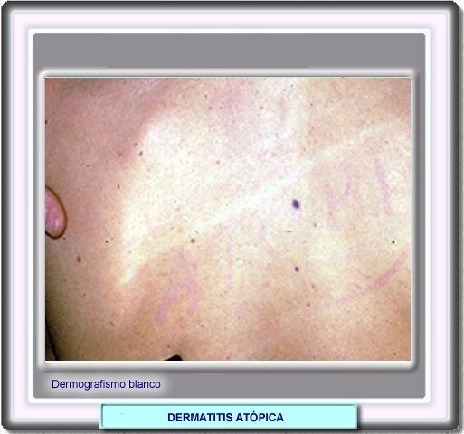 Urticaria Images & Stock Pictures. Royalty Free Urticaria ...