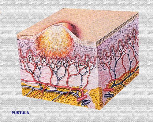 http://www.iqb.es/dermatologia/atlas/generalidades/pustula.jpg