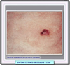 Linfoma de clulas T grandes CD30+