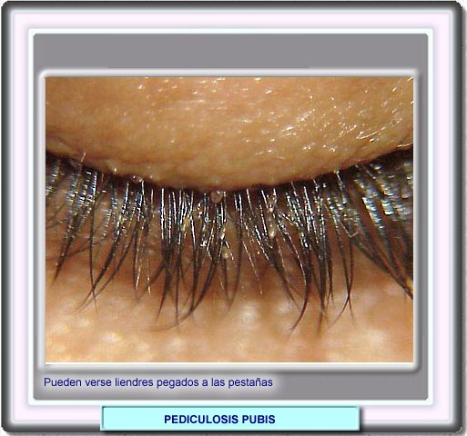 Pictures Of Pediculosis