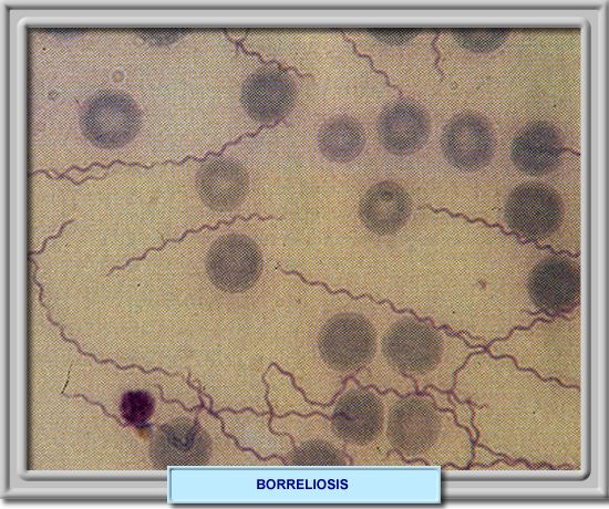 Frotis de sangre perifrica mostrando Borrelias