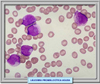 Frotis de sangre de un paciente con leucemia promieloctva