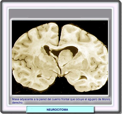 Imagen patolgica de un neurocitoma