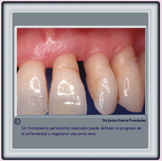 Ventajas del tratamiento periodontal
