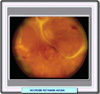 necrosis retiniana aguda