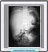 Radiografía de hemangioendotelioma hepático