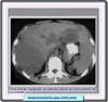 TAC de un hemangioendotelioma epiteloide