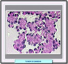 Histologia de un tumor de Dabska