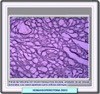 Histología de un hemangiopericitoma
