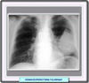 Radiografía de un hemangiopericitoma pulmonar