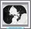 TC de una hemangiopericitoma pulmonar