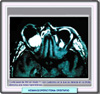 RM de un hemangiopericitoma orbital