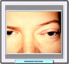 Imagen clínica de un hemangiopericitoma orbital