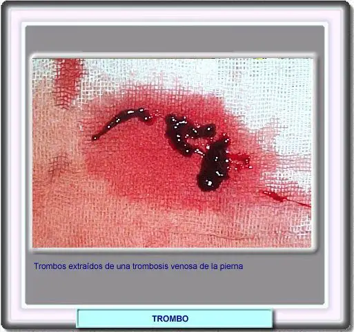 Descripción en dolor pierna sangre coágulo de el de