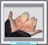 Fotografia de las manos de una paciente con enfermedad de Raynaud
