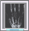 Angiografía en la enfermedad de Raynaud