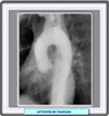 Arteritis de Takayasu