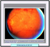 Fotografa de fondo de ojo de un edema macular difuso