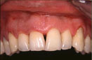 periodontitis