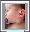 Acné neonatal