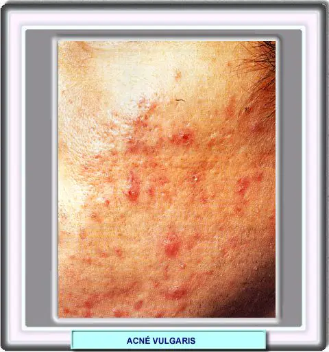Acn vulgar