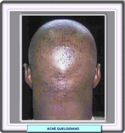 Acn queloidiniano