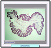 Histología del acrocordon