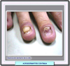 Atrofia de los dedos en la acrodermatitis continua