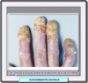 Atrofia de los dedos en la acrodermatitis continua