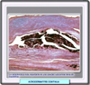 Histología de la acrodermatitis continua