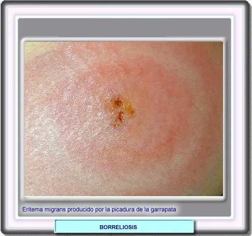 Eritema migrans
