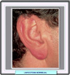 Linfocitoma en el lóbulo de la oreja