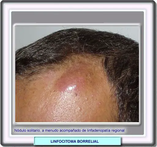 Mltiples lesiones en la fase de infeccin diseminada