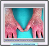 Acrodermatitis crónica atrófica
