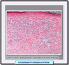 Histología de la acrodermatitis crónica atrófica