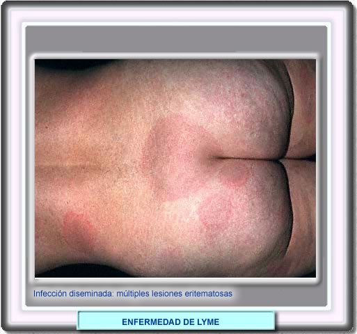 Mltiples lesiones en la fase de infeccin diseminada