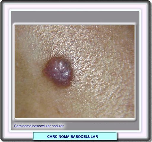 Carcinoma basocelular perlado