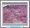 Histologa de un carcinoma basocelular morfeamrfico