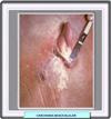 Carcinoma basocelular nodula, forma ulcero-cicatrizal