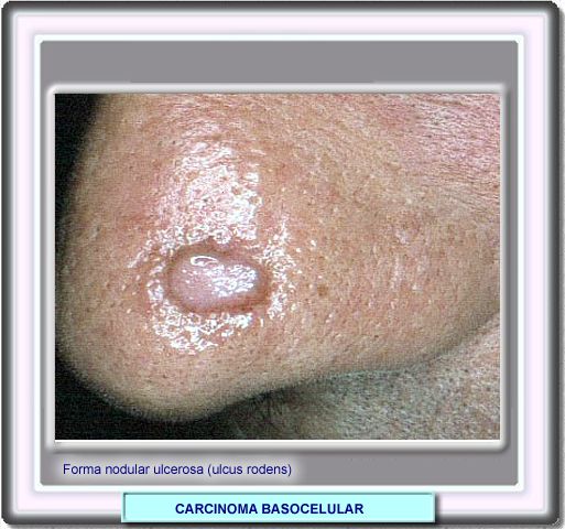 Carcinoma basocelular ulcerado nodular