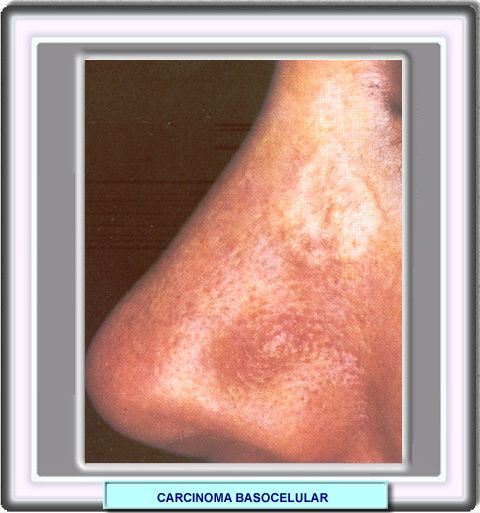 Carcinoma basocelular morfeamórfico