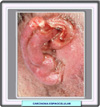 Carcinoma espinocelular en el helix